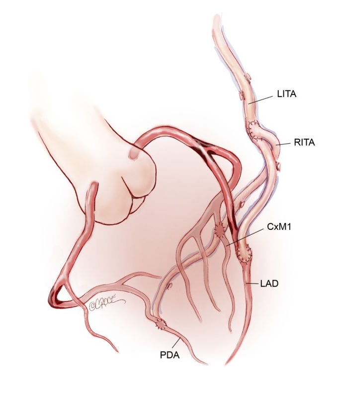 Coronary Bypass